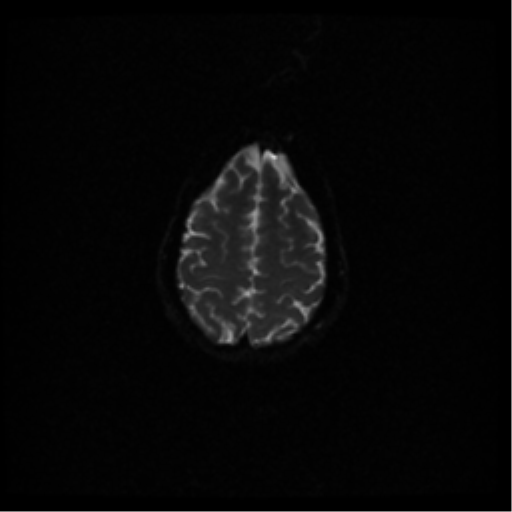 File:Acute pontine infarct from vertebral artery dissection (Radiopaedia 34111-35370 Axial DWI 43).png