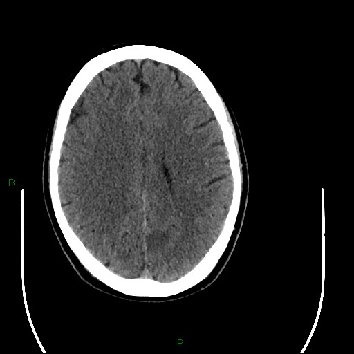 Acute posterior cerebral artery territory infarct (Radiopaedia 79329-92393 Axial non-contrast 71).jpg