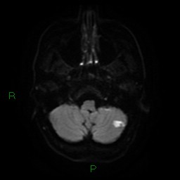 Acute posterior cerebral artery territory infarct (Radiopaedia 79329-92394 Axial DWI 6).jpg