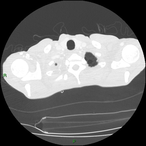 File:Acute right lung abscess (Radiopaedia 34806-36258 Axial lung window 7).jpg