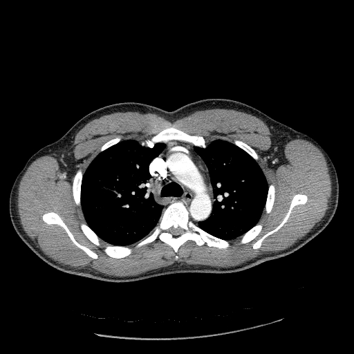 Acute segmental pulmonary emboli and pulmonary infarction (Radiopaedia 62264-70444 Axial C+ CTPA 40).jpg