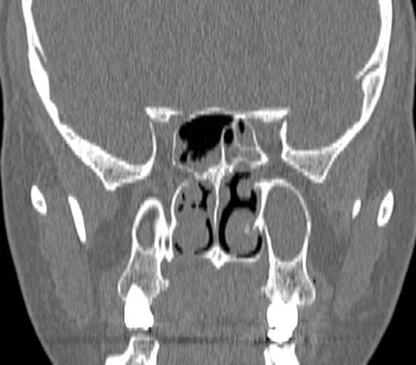 File:Acute sinusitis (Radiopaedia 40564-43158 Coronal bone window 31).jpg