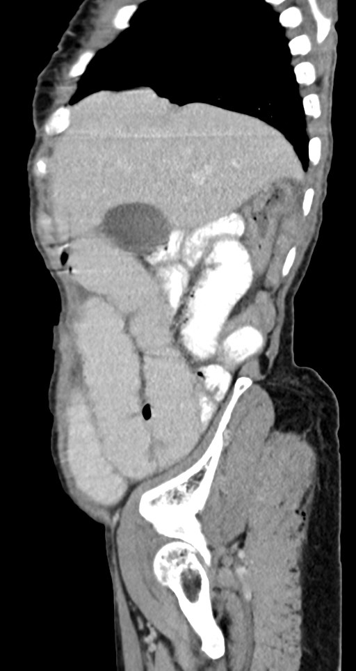 Acute small bowel (ileal) volvulus (Radiopaedia 71740-82139 Sagittal C+ portal venous phase 129).jpg