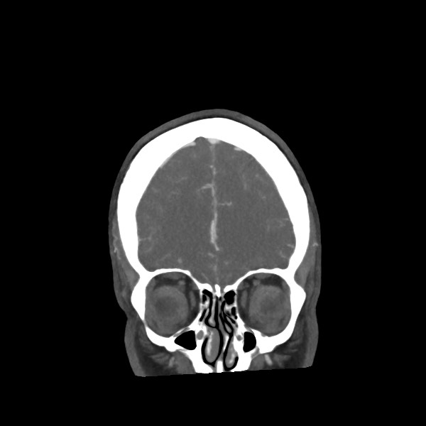 Acute subarachnoid hemorrhage and accessory anterior cerebral artery (Radiopaedia 69231-79009 Coronal C+ arterial phase 19).jpg