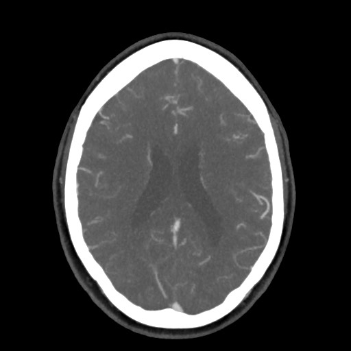 Acute subarachnoid hemorrhage and accessory anterior cerebral artery (Radiopaedia 69231-79009 D 44).jpg