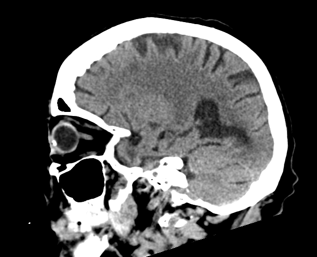 Acute traumatic subdural hematoma (Radiopaedia 82921-97257 Sagittal non-contrast 49).jpg