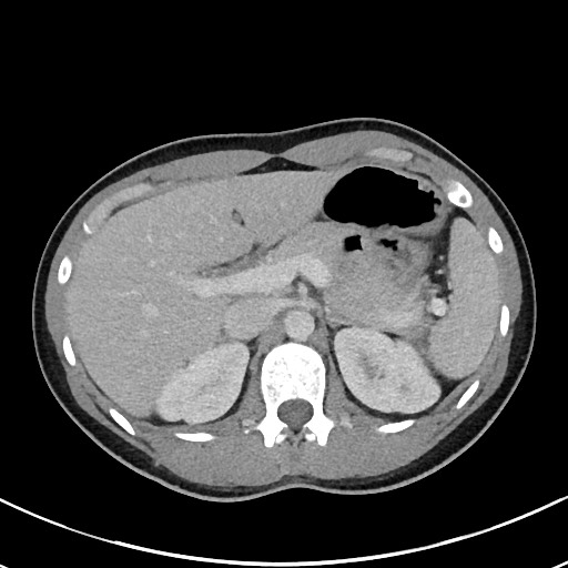 File:Acute uncomplicated appendicitis (Radiopaedia 61374-69304 Axial C+ portal venous phase 30).jpg