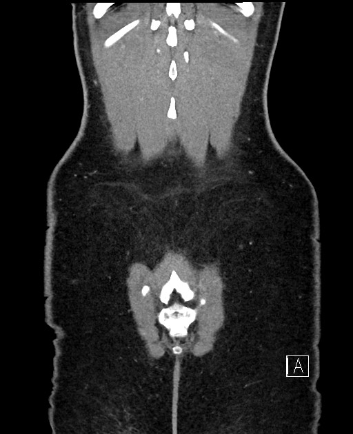 Acute uncomplicated appendicitis (Radiopaedia 61374-69304 Coronal C+ portal venous phase 99).jpg