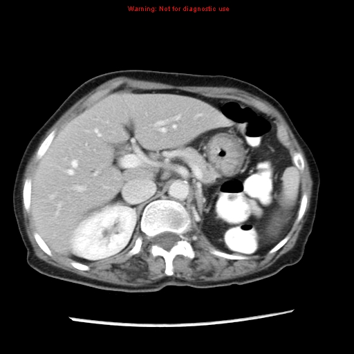 File:Adenocarcinoma of the colon (Radiopaedia 8191-9039 Axial liver window 22).jpg