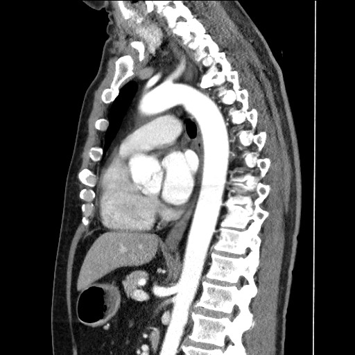 Adenocarcinoma of the lung (Radiopaedia 59871-67325 Sagittal C+ arterial phase 56).jpg