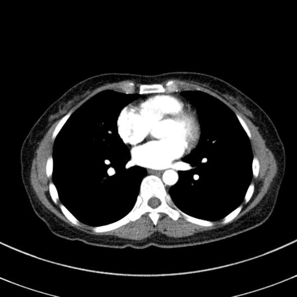File:Adenocystic carcinoma of the trachea (Radiopaedia 47677-52525 Axial C+ arterial phase 57).jpg