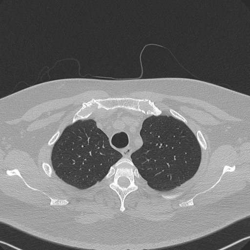 File:Adenoid cystic carcinoma of the trachea (Radiopaedia 49042-54137 Axial lung window 67).jpg
