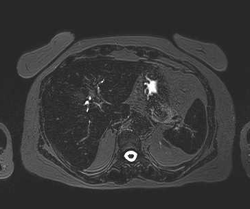 File:Adenomyomatosis of the gallbladder (Radiopaedia 50246-55587 Axial 88).png
