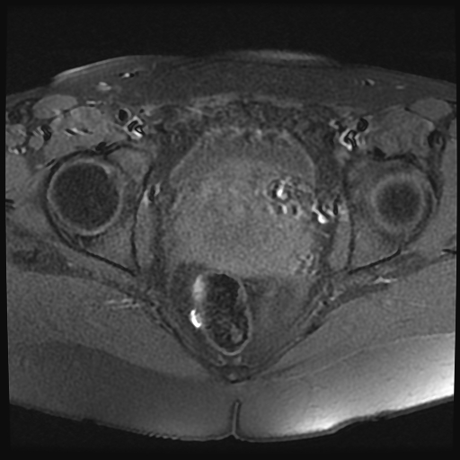File:Adenomyosis-scar endometriosis (Radiopaedia 65863-75022 Axial T1 fat sat 19).jpg