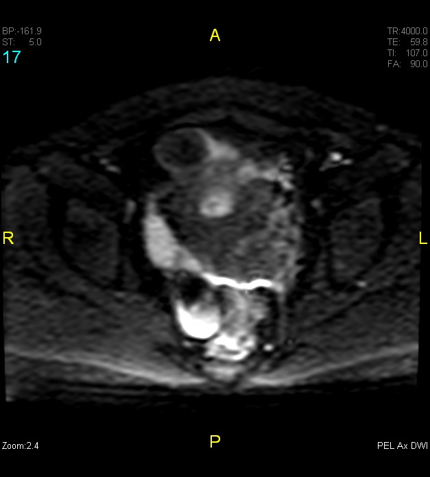 Adenomyosis (Radiopaedia 43504-46889 Axial DWI 17).jpg