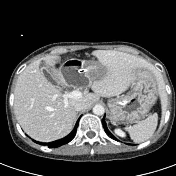 Adhesional small bowel obstruction (Radiopaedia 48397-53305 Axial C+ portal venous phase 12).jpg