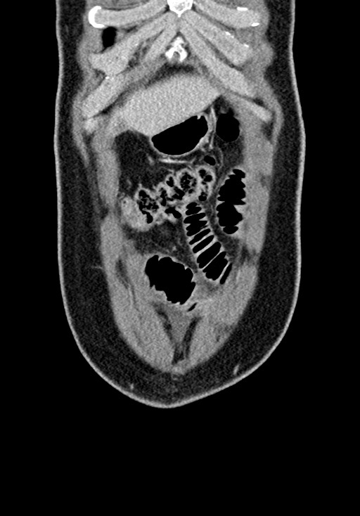 Adhesional small bowel obstruction (Radiopaedia 58900-66131 Coronal C+ portal venous phase 67).jpg