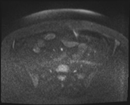 Adnexal multilocular cyst (O-RADS US 3- O-RADS MRI 3) (Radiopaedia 87426-103754 Axial DWI 61).jpg