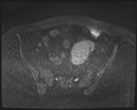 Adnexal multilocular cyst (O-RADS US 3- O-RADS MRI 3) (Radiopaedia 87426-103754 Axial DWI 67).jpg