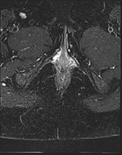 File:Adnexal multilocular cyst (O-RADS US 3- O-RADS MRI 3) (Radiopaedia 87426-103754 Axial T2 fat sat 29).jpg