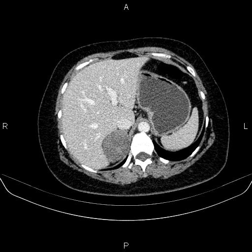 Adrenal cortical carcinoma (Radiopaedia 84882-100379 Axial C+ portal venous phase 18).jpg