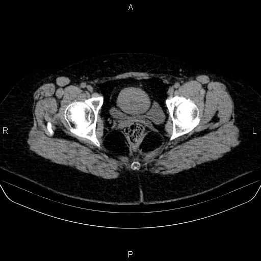File:Adrenal cortical carcinoma (Radiopaedia 84882-100379 Axial non-contrast 92).jpg