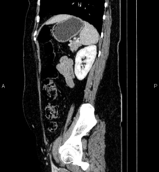 Adrenal cortical carcinoma (Radiopaedia 84882-100379 Sagittal C+ portal venous phase 67).jpg