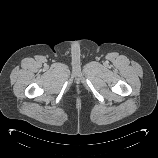 File:Adrenal cyst (Radiopaedia 45625-49776 Axial C+ portal venous phase 108).png