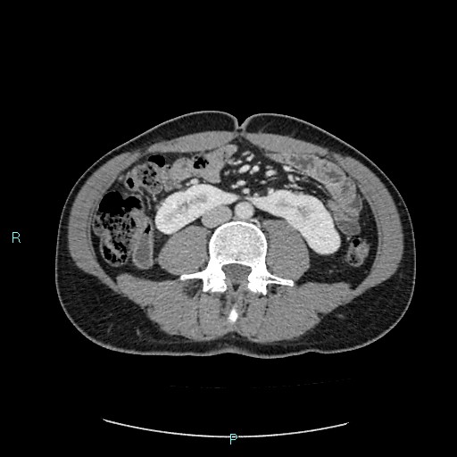 File:Adrenal cystic lymphangioma (Radiopaedia 83161-97534 Axial C+ portal venous phase 54).jpg