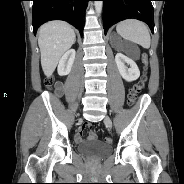 Adrenal cystic lymphangioma (Radiopaedia 83161-97534 Coronal C+ portal venous phase 48).jpg