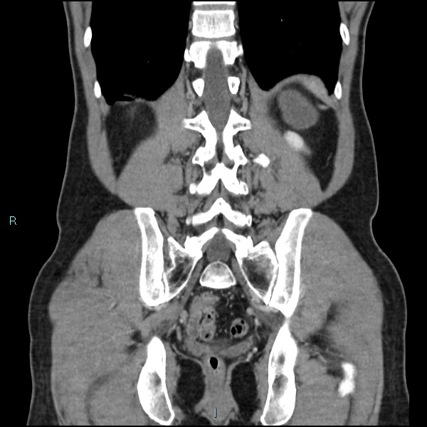 Adrenal cystic lymphangioma (Radiopaedia 83161-97534 Coronal C+ portal venous phase 58).jpg