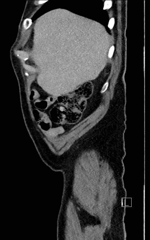 Adrenal lymphoma (Radiopaedia 73730-84529 Sagittal C+ portal venous phase 12).jpg