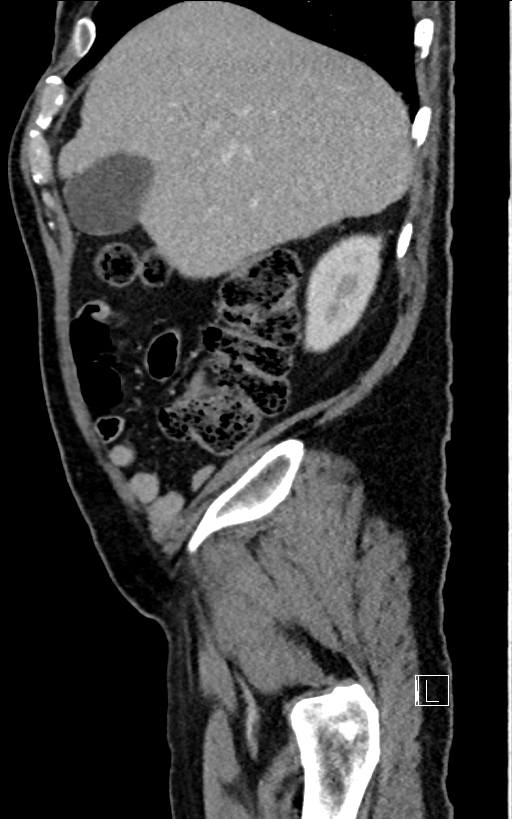 Adrenal lymphoma (Radiopaedia 73730-84529 Sagittal C+ portal venous phase 20).jpg