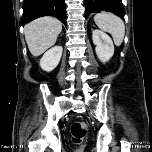 Adrenal metastasis (Radiopaedia 78425-91079 Sagittal C+ portal venous phase 50).jpg