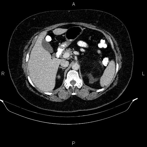 File:Adrenal myelolipoma (Radiopaedia 84319-99617 Axial renal cortical phase 38).jpg