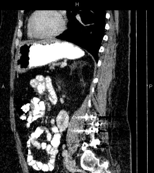 Adrenal myelolipoma (Radiopaedia 84319-99617 Sagittal renal cortical phase 61).jpg