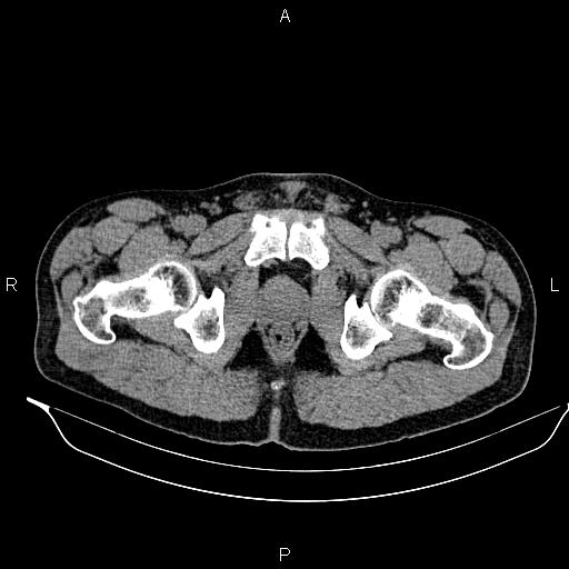 Adrenal myelolipoma (Radiopaedia 87794-104246 Axial non-contrast 108).jpg