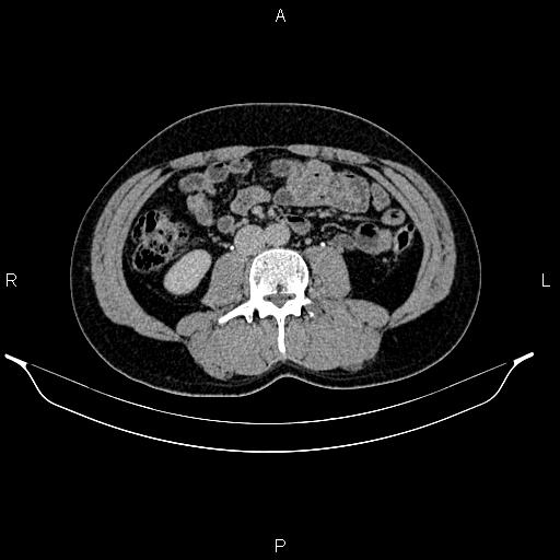 Adrenal myelolipoma (Radiopaedia 87794-104246 Axial renal excretory phase 54).jpg