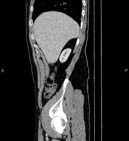 Adrenal myelolipoma (Radiopaedia 87794-104246 Sagittal renal cortical phase 15).jpg