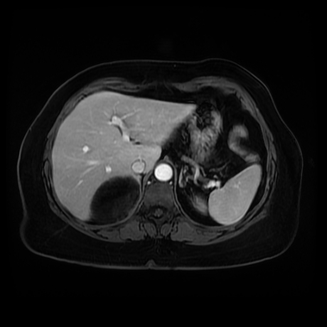 Adrenal myelolipoma - MRI (Radiopaedia 83249-97646 T1 fat sat arterial phase 20).jpg