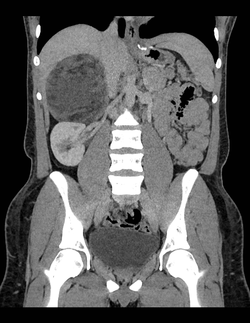 Adrenal myelolipoma - bilateral (Radiopaedia 74805-85810 Coronal C+ portal venous phase 145).jpg