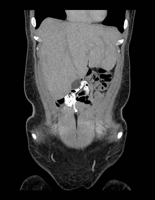 Adrenal myelolipoma - bilateral (Radiopaedia 74805-85810 Coronal C+ portal venous phase 217).jpg
