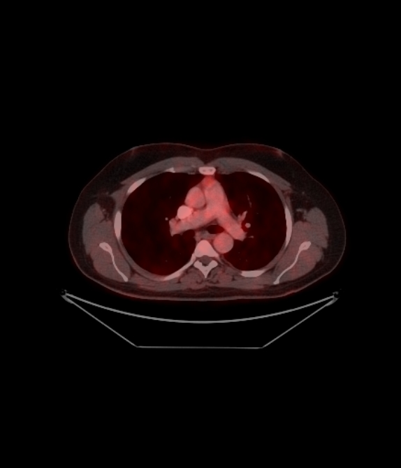 Adrenocortical carcinoma (Radiopaedia 80134-93440 ِAxial 111).jpg