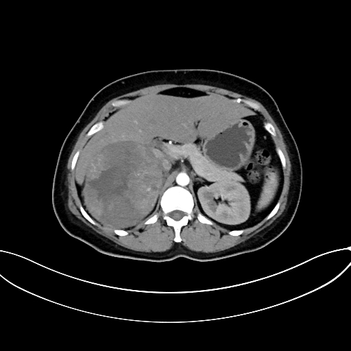 Adrenocortical carcinoma (Radiopaedia 87281-103569 Axial C+ arterial phase 30).jpg