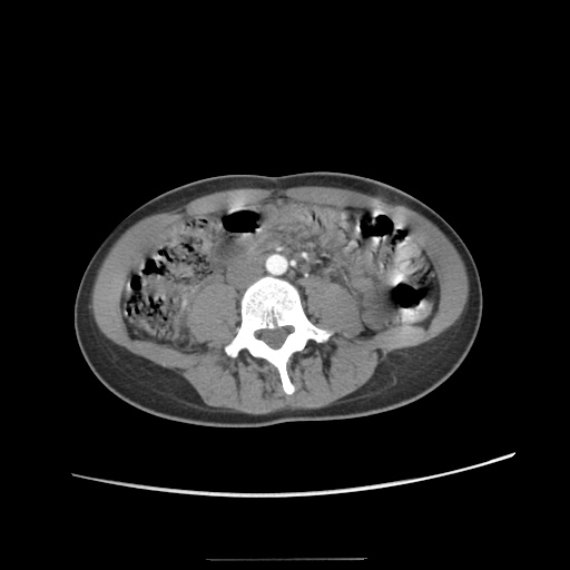 Adult polycystic kidney disease (Radiopaedia 48845-53876 Axial renal cortical phase 42).jpg