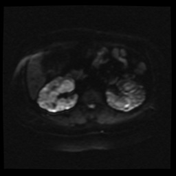 Adult polycystic kidney disease (Radiopaedia 59075-66365 Axial DWI 19).jpg