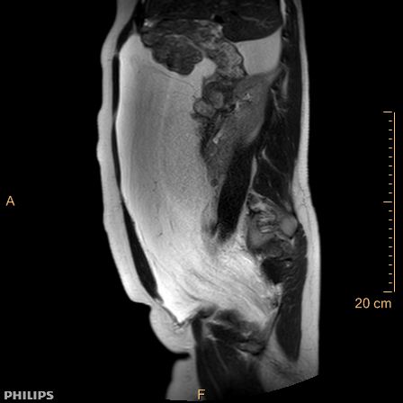 Aggressive angiomyxoma (Radiopaedia 73343-84093 Sagittal T2 22).jpg