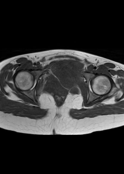 File:Aggressive angiomyxoma of the pelvis and perineum (Radiopaedia 59162-66479 T1 10).jpg