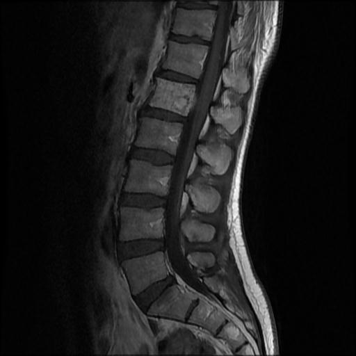 File:Aggressive vertebral hemangioma with pathological fracture (Radiopaedia 69528-79411 Sagittal T1 C+ 5).jpg