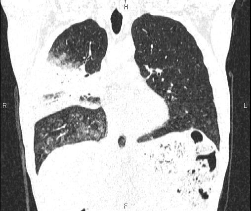 Air bronchogram in pneumonia (Radiopaedia 85719-101512 Coronal lung window 26).jpg